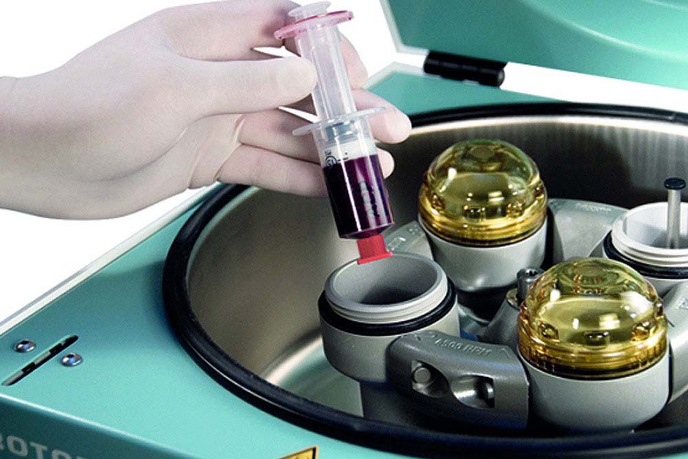Arthrex prp - the latest innovation for lowering prp therapy costs 1 arthrex-prp